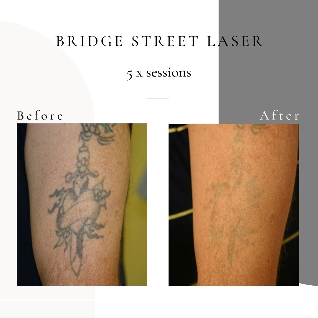 Tattoo removal chester