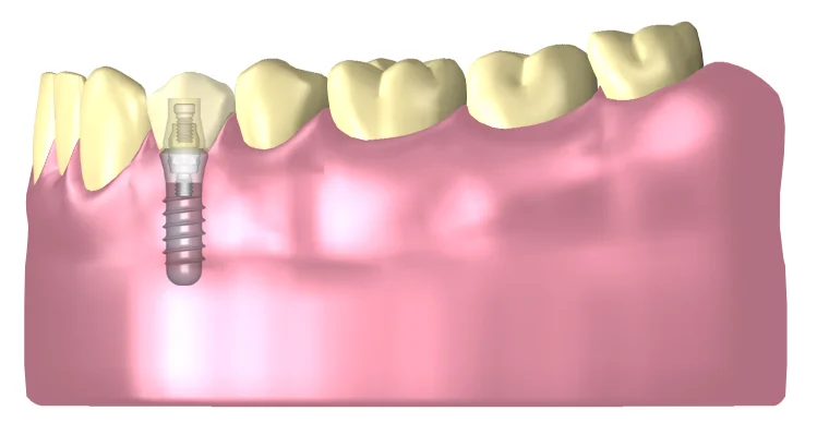 schwerpunkte_implantate_big.jpg