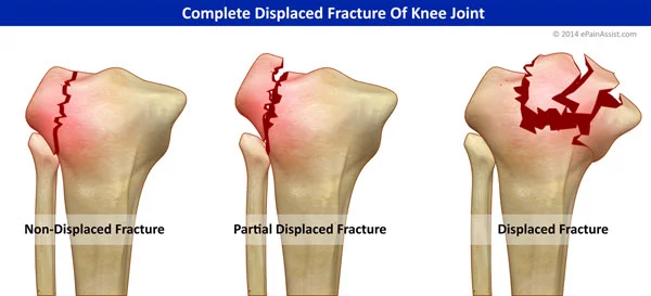 causes of knee pain