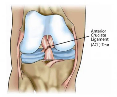causes of knee pain