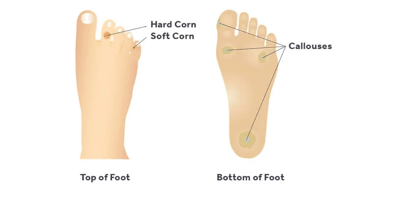 corn on edge of foot