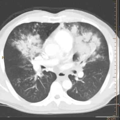 pneumonia_(Monday-05-2018_20-52-47-7204).jpg