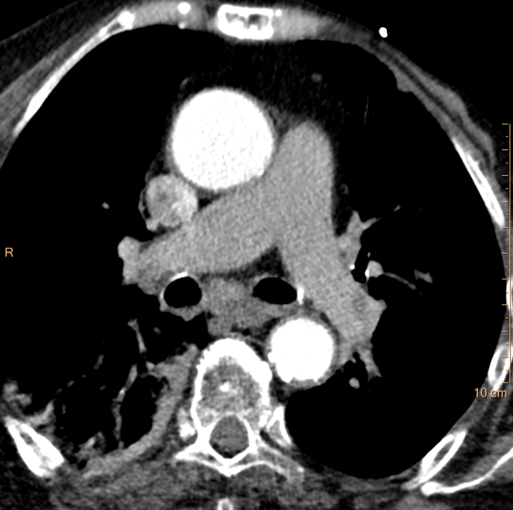 Salvage bad CT PE scans
