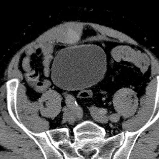 Rectus sheath hematoma