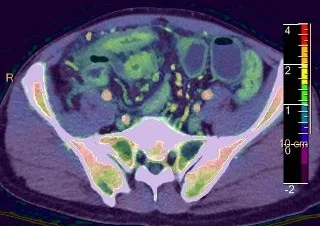 Fused+Series+crohn+1_(Tuesday-06-2018_13-29-38-6342).jpg