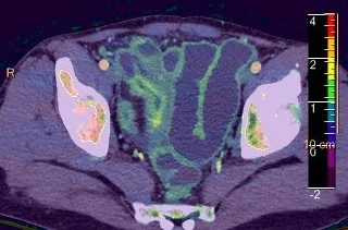 Fused+Series+crohn+3_(Tuesday-06-2018_13-30-48-9852).jpg
