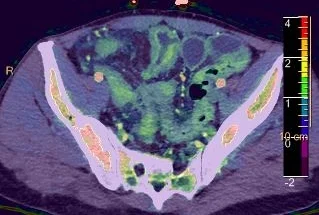Crohn disease