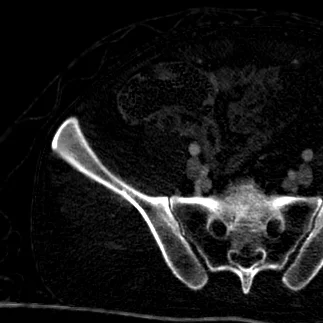 Appendicitis