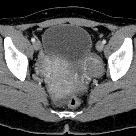 hem+cyst+1.jpg