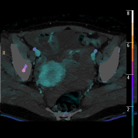 Pelvic mass