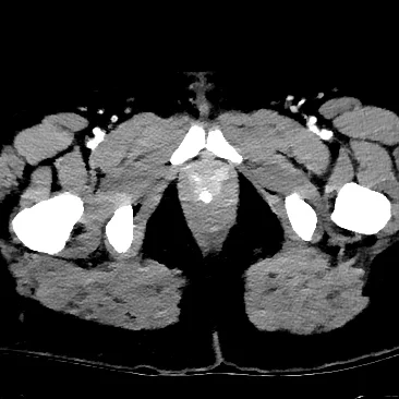 vag+nodule+2.jpg
