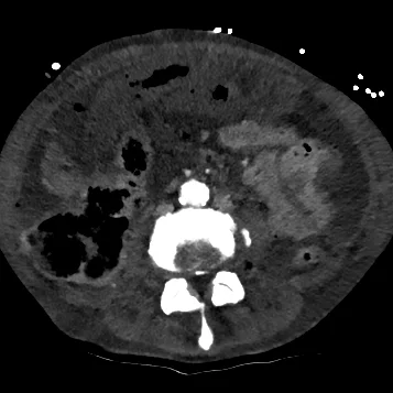 Bowel ischemia