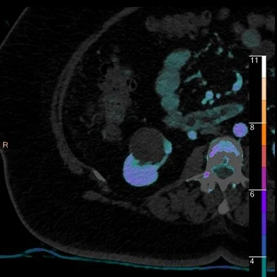 Complex kidney cyst