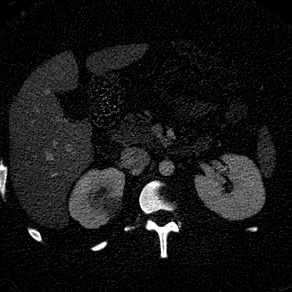 Pyelonephritis