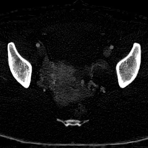 Hemorrhagic cyst