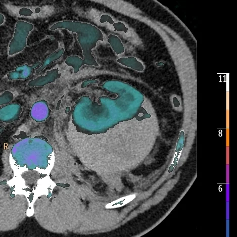 Perinephric hematoma