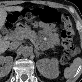 Jejunal hyperdensity
