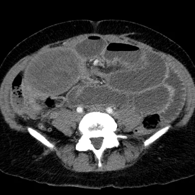 fibroidSBO11.jpg