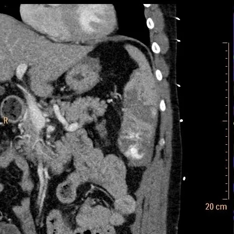 spleen injury_(Tuesday-13-2018_08-37-43-4034).jpg