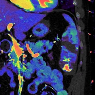 Spleen injury
