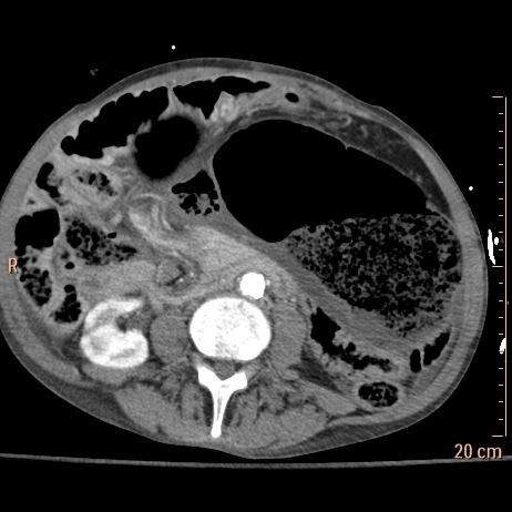 Conventional CT with dilated malpositioned cecum