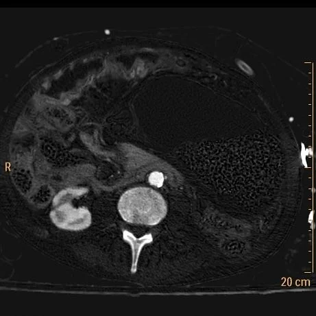 Iodine map with no perfusion in wall of cecum and terminal ileum