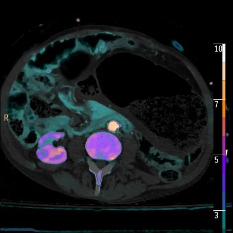 Iodine density overlay with no perfusion in wall of cecum and terminal ileum