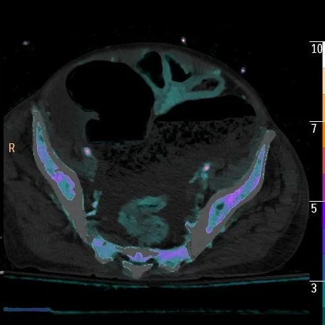 Dilated segment of colon extends into pelvis, note absent perfusion in the wall on overlay image