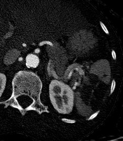 Splenic infarct