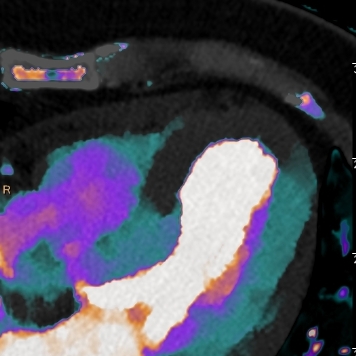 Myocardial infarction