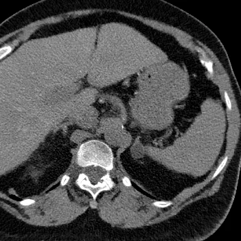 Virtual non-contrast with attenuation of -7 HU, diagnostic of a benign adenoma