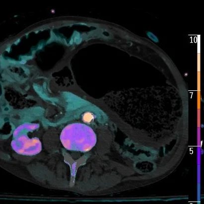 Internal hernia with necrotic colon