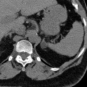 Adrenal "incidentaloma"