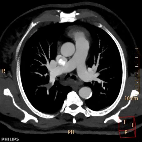 Low-contrast dose CT PE