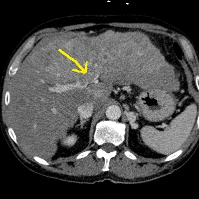 Conventional CT with filling defect in portal vein (yellow arrow)