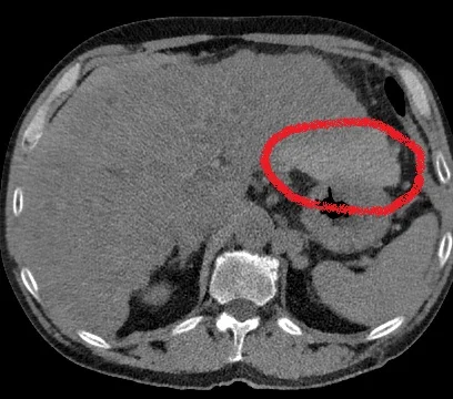 Virtual non-contrast shows bleed adjacent to the left lobe