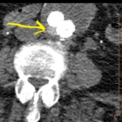 Conventional CT with focal hyperdensity adjacent to endograft
