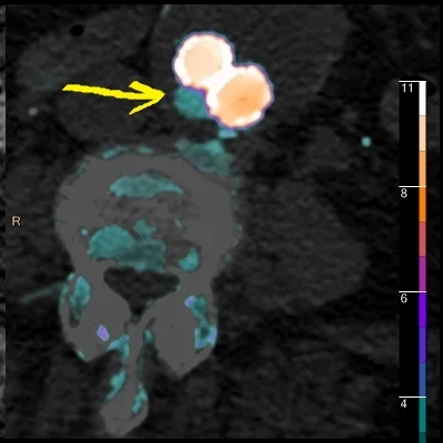 Fusion image nicely depicts the endoleak