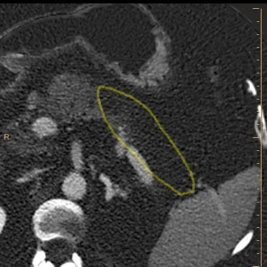 Iodine map shows absent perfusion (outlined in yellow), consistent with necrosis in body and tail