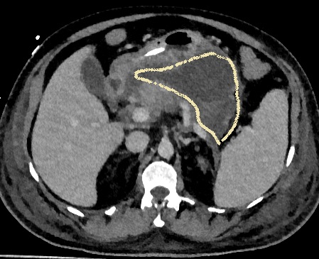 CT few weeks later shows large necrotic collection (outlined)
