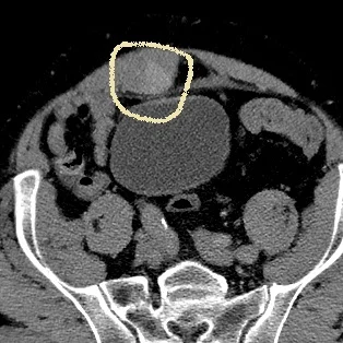 Virtual non-contrast shows rectus sheath hematoma much better (outlined)