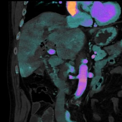 Intrahepatic biliary calculi