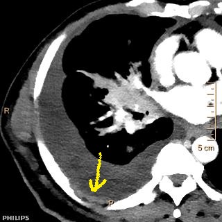 40 keV image clearly depicts the pleural tumor deposit.