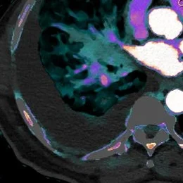Pleural effusion