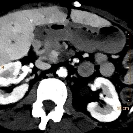 Nodule is much easier to see on 40 keV image