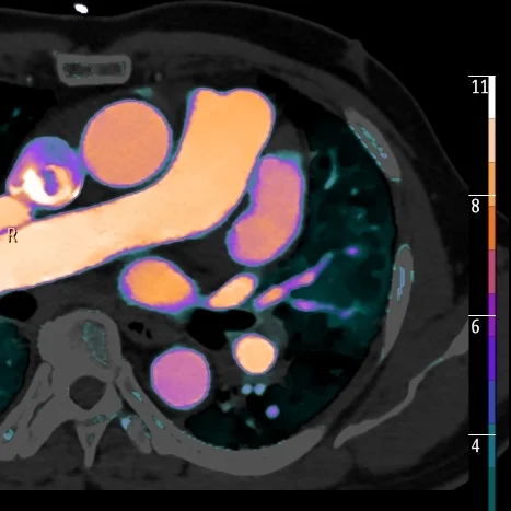 Fusion image nicely demonstrates lack of iodine uptake in clot