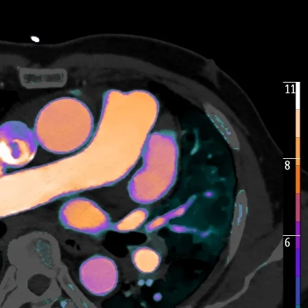 Left atrial appendage clot