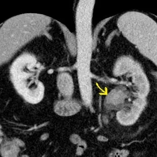 Conventional image with filling defect in left renal pelvis (yellow arrow)