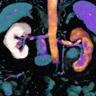 Iodine overlay with uptake confirms neoplasm