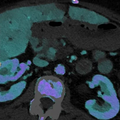 Pancreatic cancer